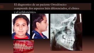 El diagnostico de un paciente Ortodóncico
comprende dos aspectos bién diferenciados, el clínico
y el cefalométrico.
 