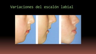 Variaciones del escalón labial
 