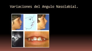 Variaciones del Angulo Nasolabial.
 