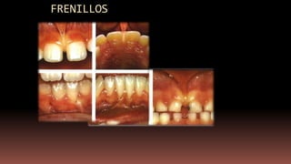 FRENILLOS
 