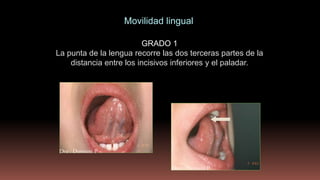 GRADO 1
La punta de la lengua recorre las dos terceras partes de la
distancia entre los incisivos inferiores y el paladar.
Movilidad lingual
Dra . Damiani P
Dra . Damiani P
 