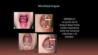 GRADO 2:
La punta de la
lengua llega hasta
media trayectoria
entre los incisivos
inferiores y el
paladar.
G.G.
Movilidad lingual
Dra . Damiani P
 