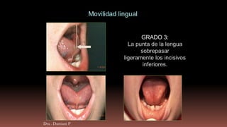 GRADO 3:
La punta de la lengua
sobrepasar
ligeramente los incisivos
inferiores.
Movilidad lingual
Dra . Damiani P
 