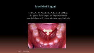 GRADO 4 : ANQUILOGLOSIA TOTAL
La punta de la lengua no logra realizar la
movilidad normal, encontrándose muy limitada.
Movilidad lingual
Dra . Damiani P
 