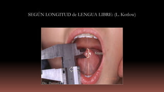 8mm
SEGÚN LONGITUD de LENGUA LIBRE: (L. Kotlow)
Dra . Damiani P
 
