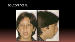 DOLICOFACIAL
 