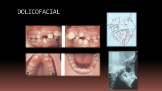 DOLICOFACIAL
 