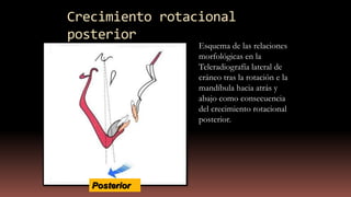 Crecimiento rotacional
posterior
Posterior
Esquema de las relaciones
morfológicas en la
Teleradiografía lateral de
cráneo tras la rotación e la
mandíbula hacia atrás y
abajo como consecuencia
del crecimiento rotacional
posterior.
 