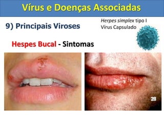 Vírus e Doenças Associadas
9) Principais Viroses
Hespes Bucal - Sintomas
Herpes simplex tipo I
Vírus Capsulado
 
