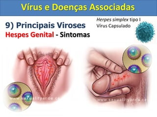 Vírus e Doenças Associadas
9) Principais Viroses
Hespes Genital - Sintomas
Herpes simplex tipo I
Vírus Capsulado
 