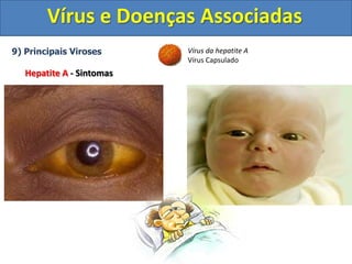 Vírus e Doenças Associadas
9) Principais Viroses
Hepatite A - Sintomas
Vírus da hepatite A
Vírus Capsulado
 