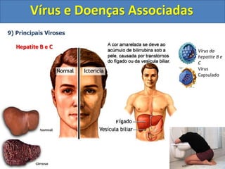 Vírus e Doenças Associadas
Vírus da
hepatite B e
C
Vírus
Capsulado
9) Principais Viroses
Hepatite B e C
 
