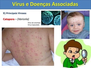Vírus e Doenças Associadas
9) Principais Viroses
Catapora – (Varicela)
Vírus do sarampo
Vírus Capsulado
 