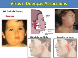 Vírus e Doenças Associadas
9) Principais Viroses
Caxumba
 