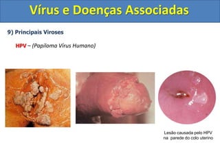 Vírus e Doenças Associadas
9) Principais Viroses
HPV – (Papiloma Vírus Humano)
Lesão causada pelo HPV
na parede do colo uterino
 