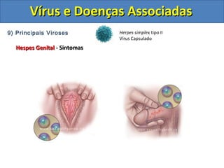 Vírus e Doenças AssociadasVírus e Doenças Associadas
9) Principais Viroses
Hespes GenitalHespes Genital - Sintomas- Sintomas
Herpes simplex tipo II
Vírus Capsulado
 