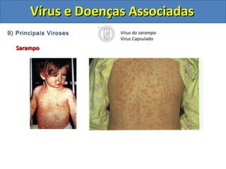 Vírus e Doenças AssociadasVírus e Doenças Associadas
9) Principais Viroses
SarampoSarampo
Vírus do sarampo
Vírus Capsulado
 