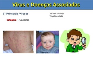 Vírus e Doenças AssociadasVírus e Doenças Associadas
9) Principais Viroses
CataporaCatapora – (Varicela)
Vírus do sarampo
Vírus Capsulado
 
