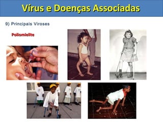 Vírus e Doenças AssociadasVírus e Doenças Associadas
9) Principais Viroses
PoliomielitePoliomielite
 