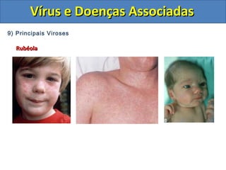 Vírus e Doenças AssociadasVírus e Doenças Associadas
9) Principais Viroses
RubéolaRubéola
 