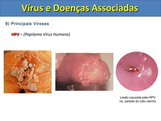 Vírus e Doenças AssociadasVírus e Doenças Associadas
9) Principais Viroses
HPVHPV – (Papiloma Vírus Humano)
Lesão causada pelo HPV
na parede do colo uterino
 