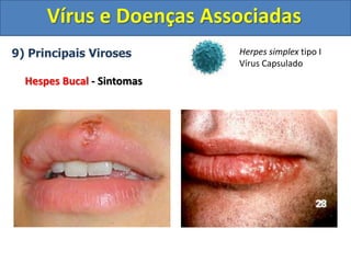 Vírus e Doenças Associadas
9) Principais Viroses
Hespes Bucal - Sintomas
Herpes simplex tipo I
Vírus Capsulado
 