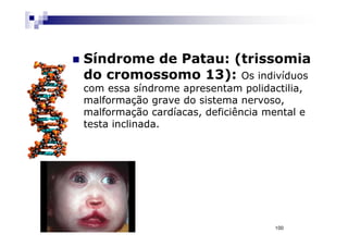 Síndrome de Patau: (trissomia
do cromossomo 13): Os indivíduos
com essa síndrome apresentam polidactilia,
malformação grave do sistema nervoso,
malformação cardíacas, deficiência mental e
testa inclinada.




                                     100
 