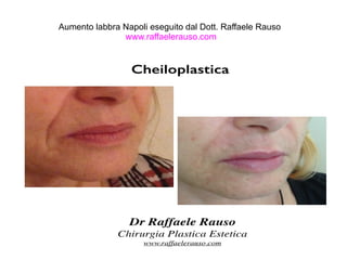 Aumento labbra Napoli eseguito dal Dott. Raffaele Rauso 
www.raffaelerauso.com 
 