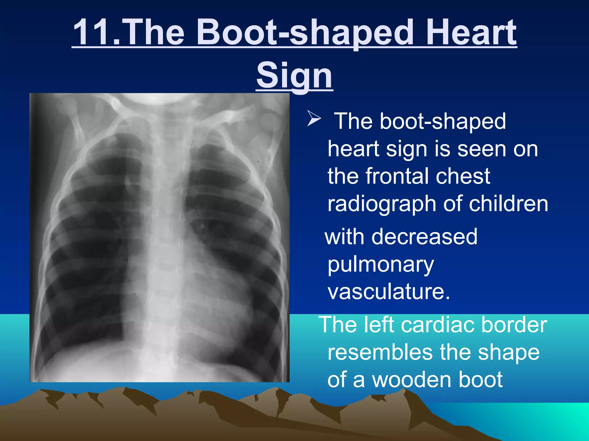 Radiology signs | PPT