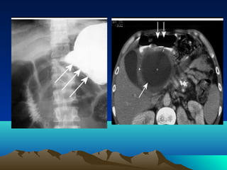 Radiology signs | PPT