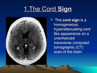 the radiological signs in imaging of gastro Aunt minnie signs.ppt