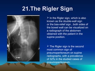 the radiological signs in imaging of gastro Aunt minnie signs.ppt