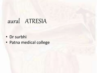 aural ATRESIA
• Dr surbhi
• Patna medical college
 