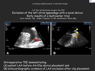 Intraoperative TEE demonstrating
(A) patent LAA before AtriClip device placement and
(B) echocardiographic evidence of LAA exclusion after clip placement.
J of Thor and Cardiovasc Surgery, Nov 2011
Exclusion of the left atrial appendage with a novel device:
Early results of a multicenter trial
Gorav Ailawadi, MD,…..Ralph J. Damiano, Jr, MD and Michael J. Mack, MDg
La chiusura dell’auricola sn: il ruolo del chirurgo
 
