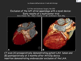 CT scan (A) preoperatively demonstrating patent LAA lumen and
(B) postoperatively at 3 months after AtriClip device
insert...