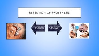 RETENTION OF PROSTHESIS
Implants Adhesive
 