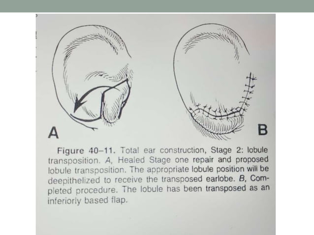 Auricular reconstruction | PPTX