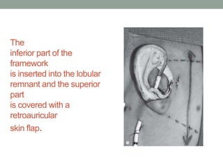 The
inferior part of the
framework
is inserted into the lobular
remnant and the superior
part
is covered with a
retroauricular
skin flap.
 