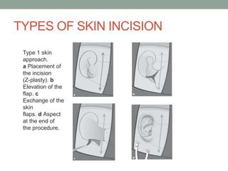 TYPES OF SKIN INCISION
Type 1 skin
approach.
a Placement of
the incision
(Z-plasty). b
Elevation of the
flap. c
Exchange of the
skin
flaps. d Aspect
at the end of
the procedure.
 
