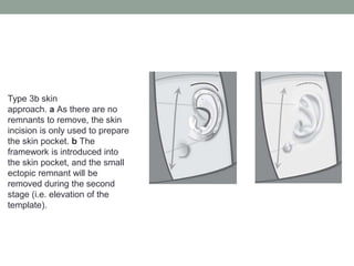 Type 3b skin
approach. a As there are no
remnants to remove, the skin
incision is only used to prepare
the skin pocket. b The
framework is introduced into
the skin pocket, and the small
ectopic remnant will be
removed during the second
stage (i.e. elevation of the
template).
 