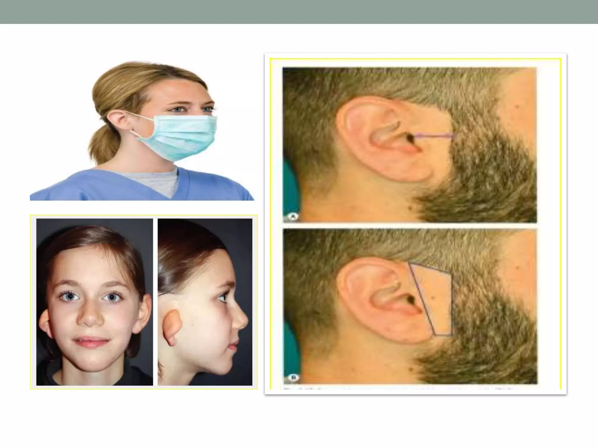 AURICULAR Reconstruction 1.pptx