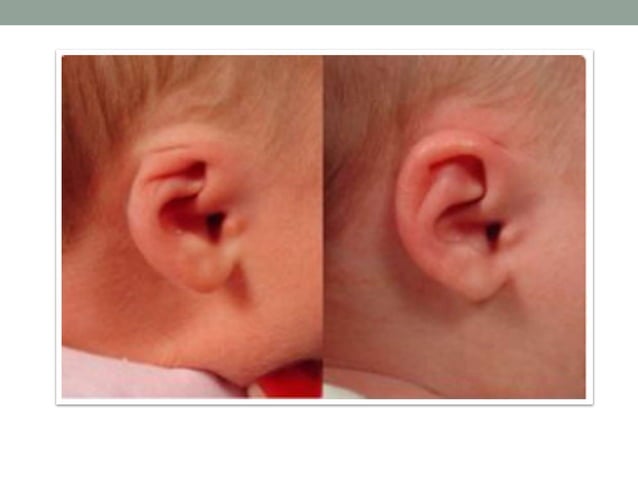 AURICULAR Reconstruction 1.pptx