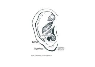 Ponto Lobular para Cicatrizes Psíquicas
 