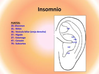 Insomnio
PUNTOS:
20.-Shenmen
35.- Riñón
36.- Vesícula biliar (oreja derecha)
37.- Hígado
27.- Estomago
47.- Corazón
79.- Subcortex
20
35
79
47
27
36
37
 