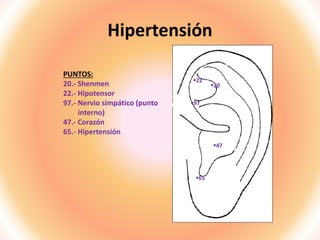 Hipertensión
PUNTOS:
20.- Shenmen
22.- Hipotensor
97.- Nervio simpático (punto
interno)
47.- Corazón
65.- Hipertensión
20
22
65
97
47
 