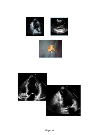 Echo in ischaemic heart disease and Myocardial infarction | PDF