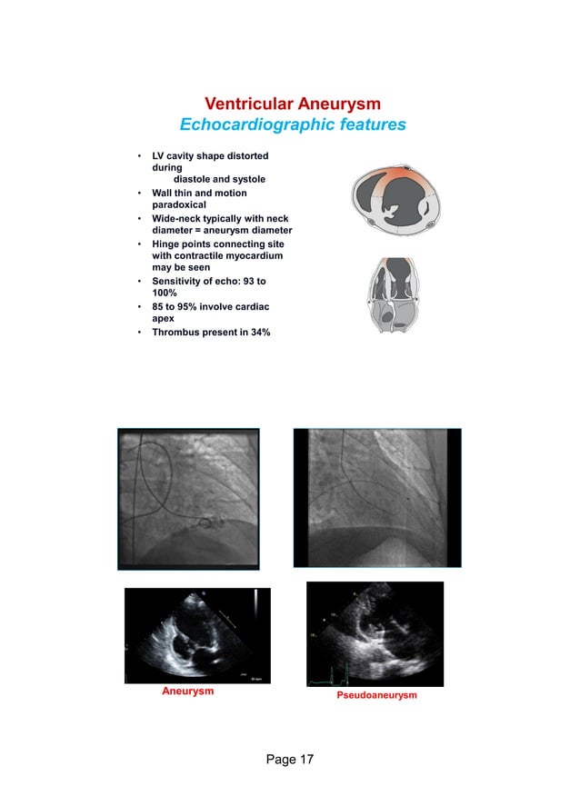 Echo in ischaemic heart disease and Myocardial infarction | PDF