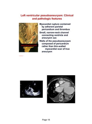 Echo in ischaemic heart disease and Myocardial infarction | PDF