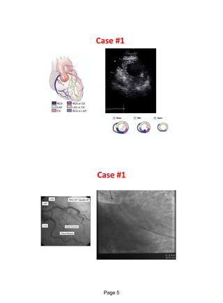 Echo in ischaemic heart disease and Myocardial infarction | PDF