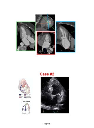 Echo in ischaemic heart disease and Myocardial infarction | PDF